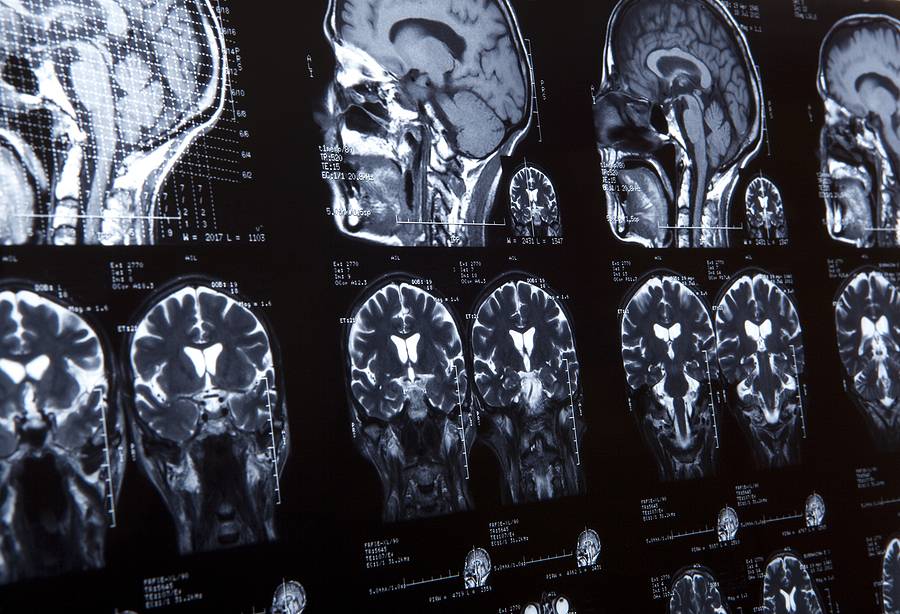Seven Common Myths About Brain Injury